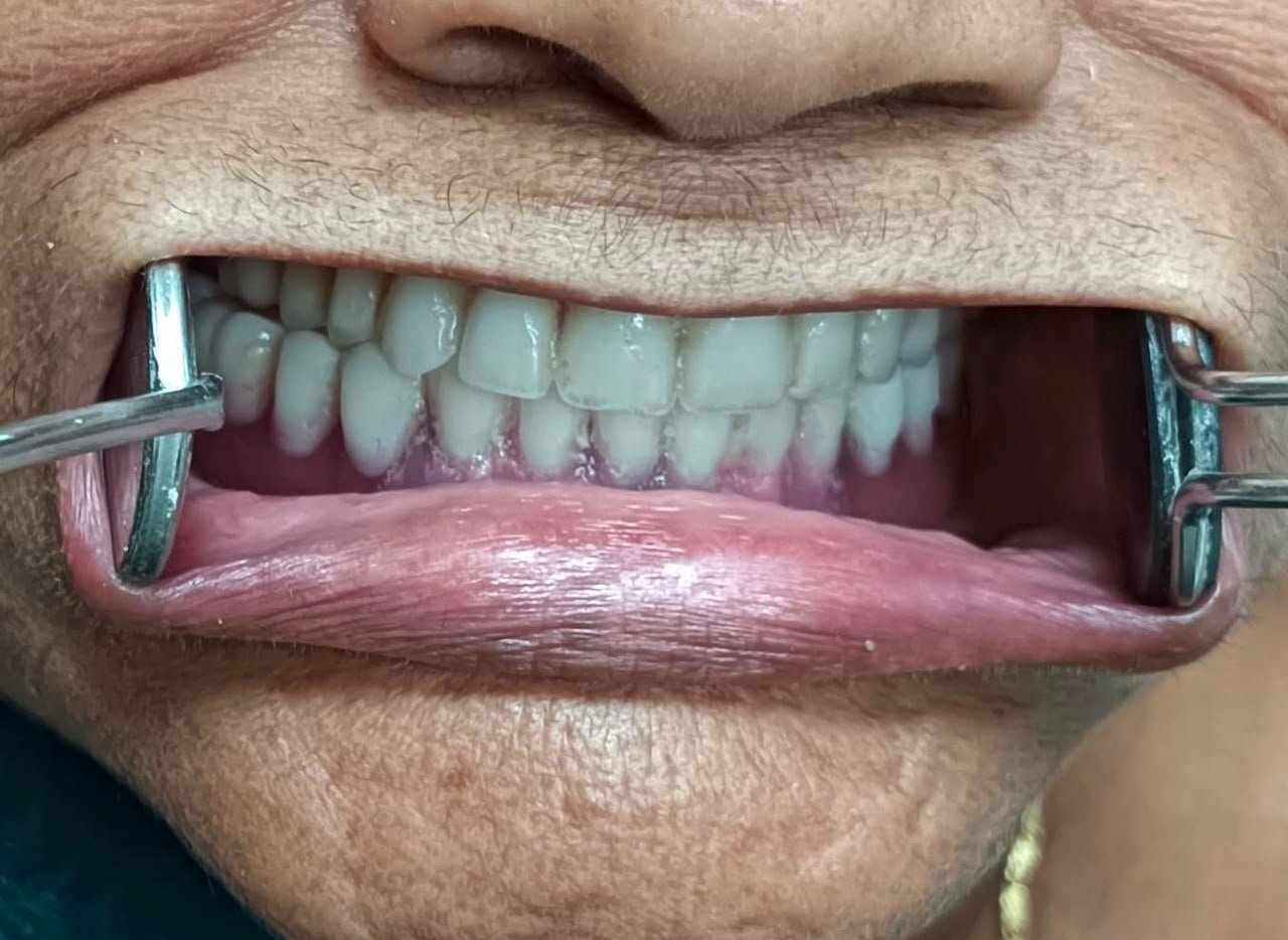 Lower Overdenture Implants After Treatment Result